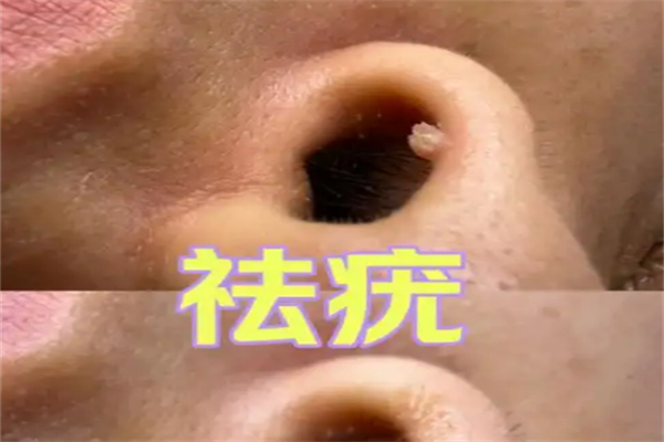 绣江南祛疣