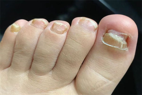甲美天下灰指甲